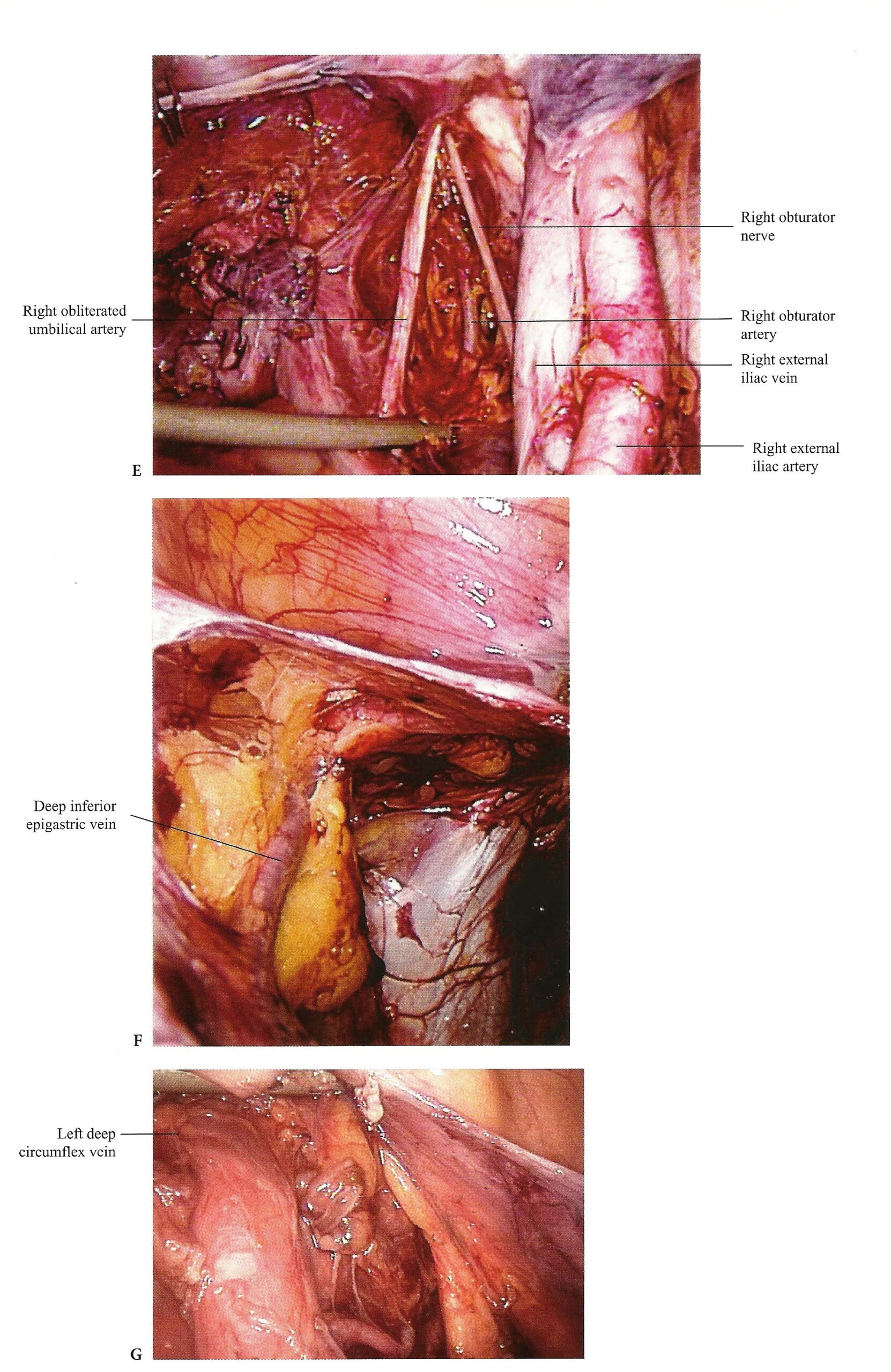 Society of Laparoscopic & Robotic Surgeons Intraperitoneal and