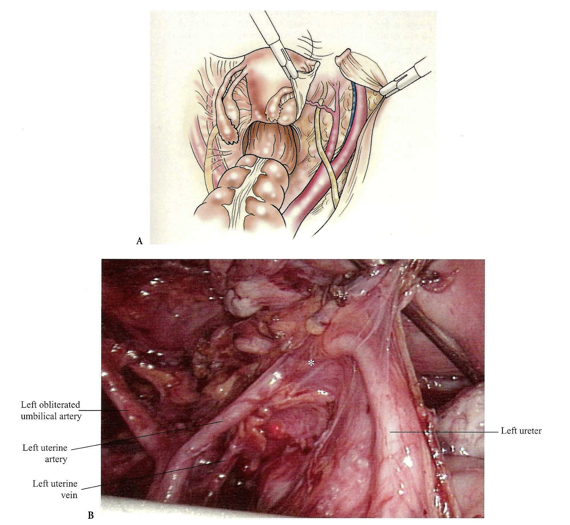 Society of Laparoscopic & Robotic Surgeons Intraperitoneal and