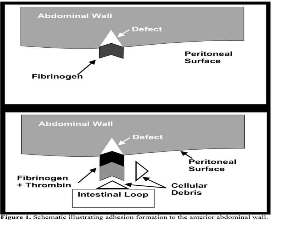 Adhesions and Adhesiolysis Society of Laparoscopic & Robotic Surgeons
