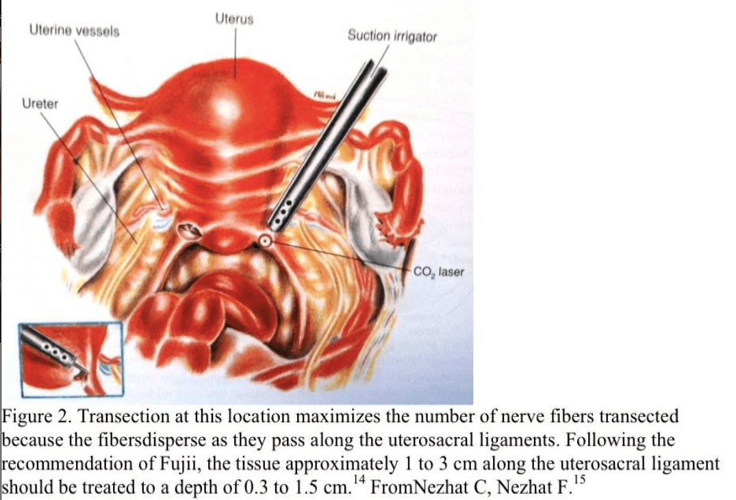 Society of Laparoscopic & Robotic Surgeons Laparoscopic Treatment of