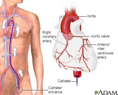 Aortic Angiography