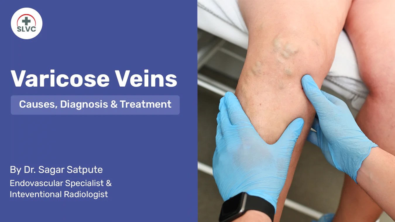 Varicose Veins Causes, Diagnosis & Treatment