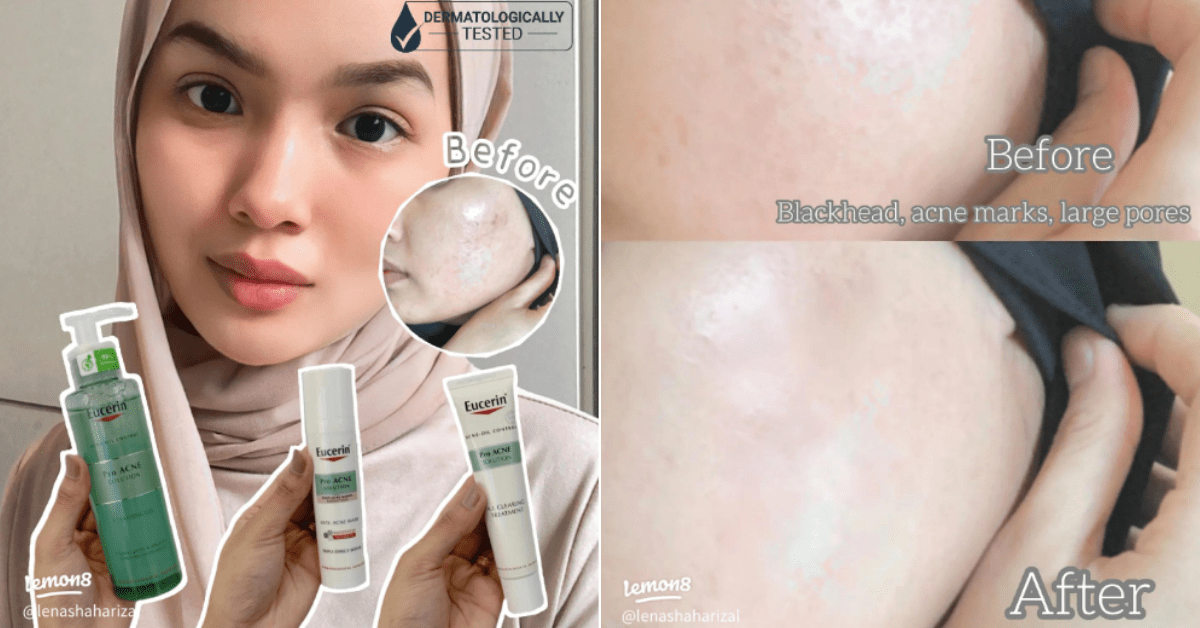 “My Acne & Acne Marks Are Slowly Fading” M’sians Share Reviews of Eucerin’s Acne Range Life