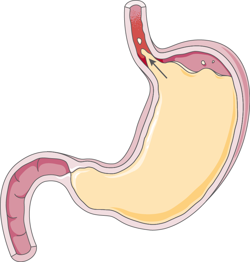 Gastroesophageal reflux disease (GERD) Servier Medical Art