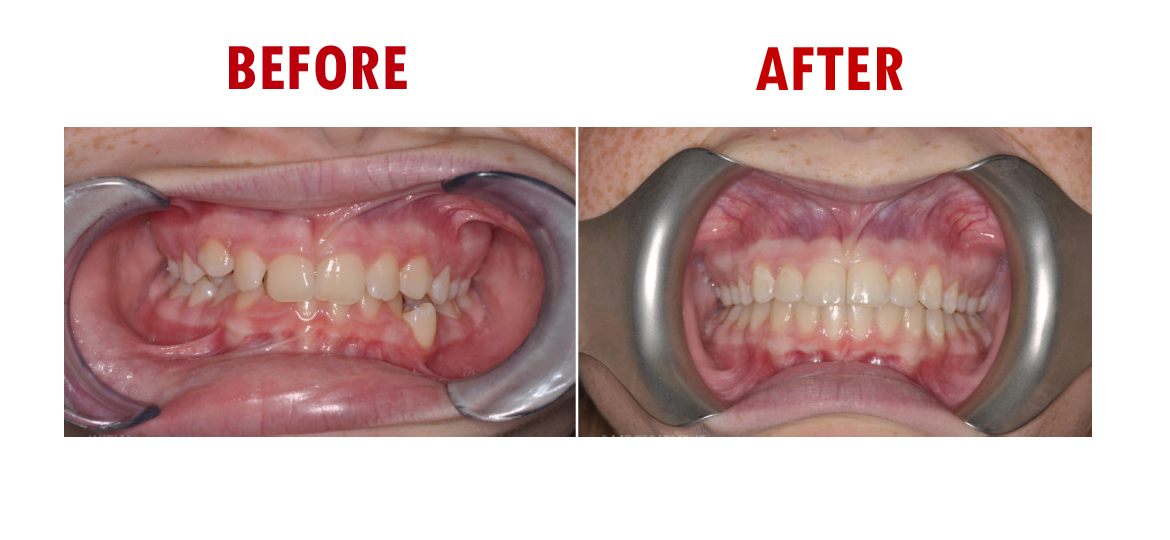 Smart Braces in Ludhiana Orthodontist Specialist