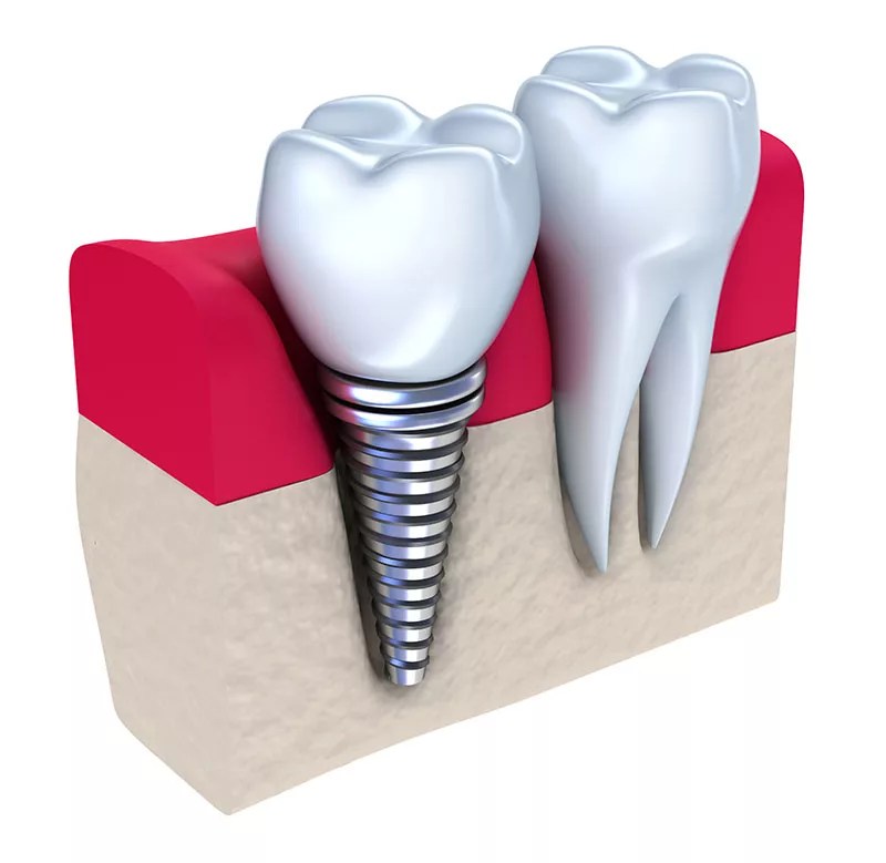 The Oaks Dental Center Dental Implants The Oaks Dental Center