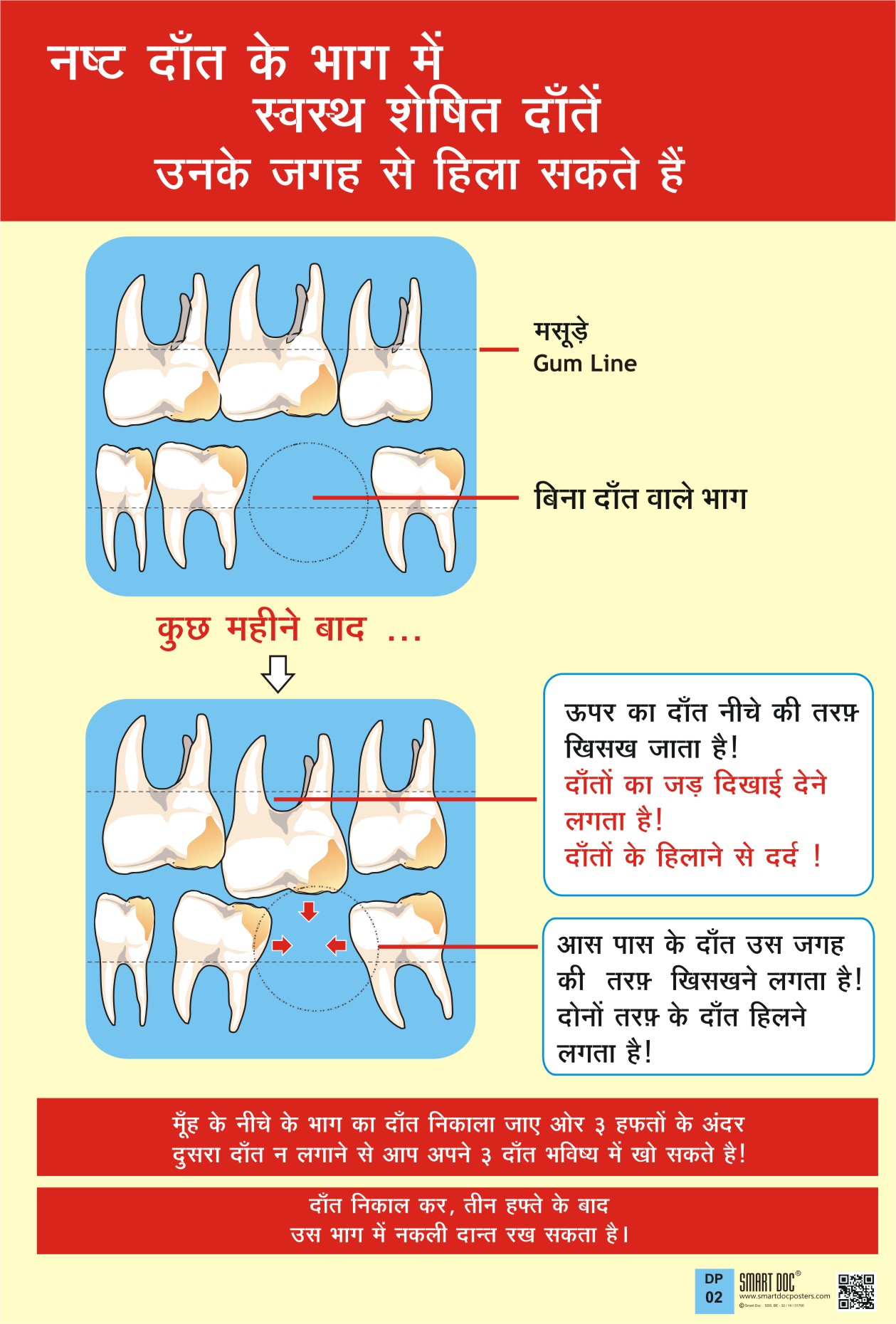 How missing teeth causes mobility of other teeth (Hindi) DP02H