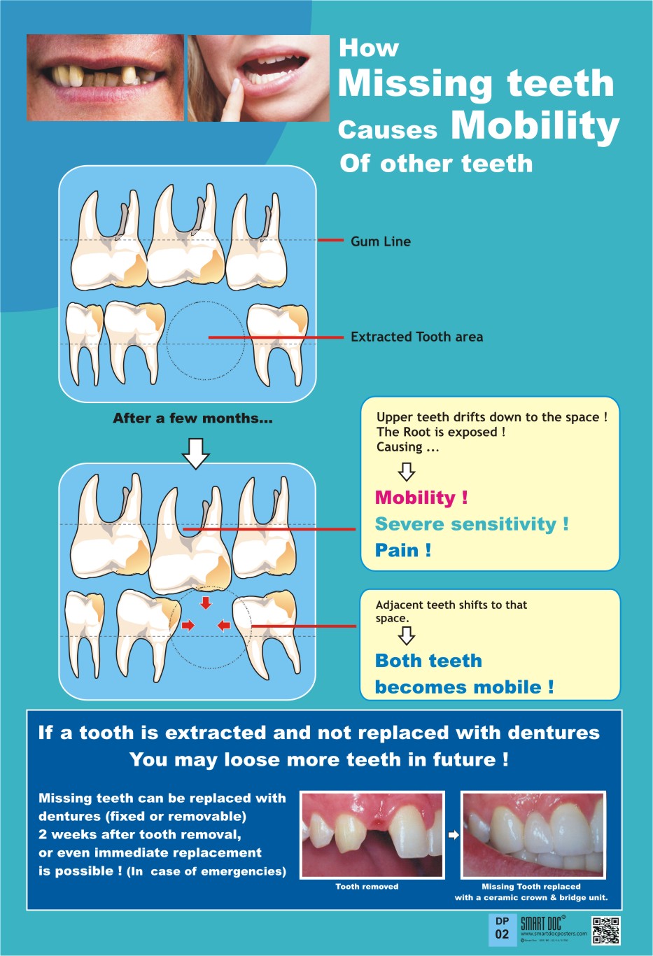 How missing teeth causes mobility of other teeth (Eng.) DP02 Smart