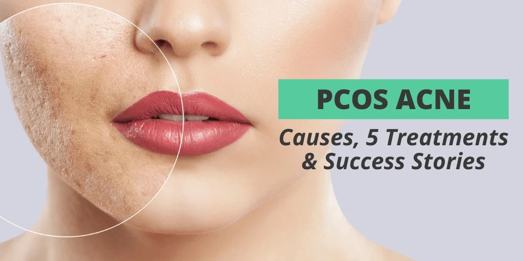 PCOS Acne Causes, 5 Treatments, & Success Stories