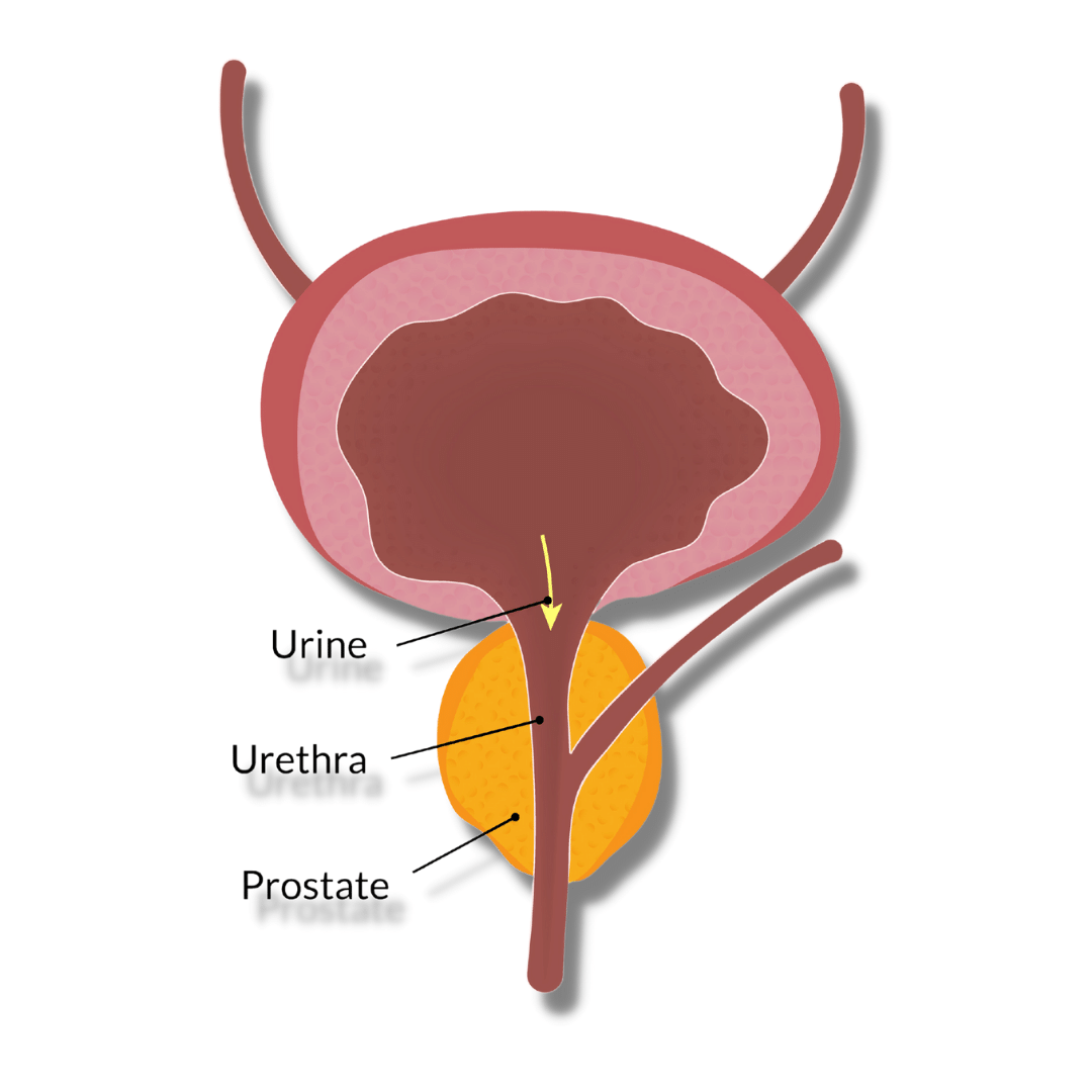Managing Incontinence after Prostate Surgery The What, Why, and What
