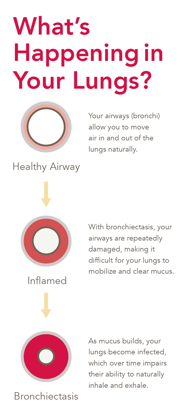 How Did I Get Bronchiectasis? SmartVest Airway Clearance System