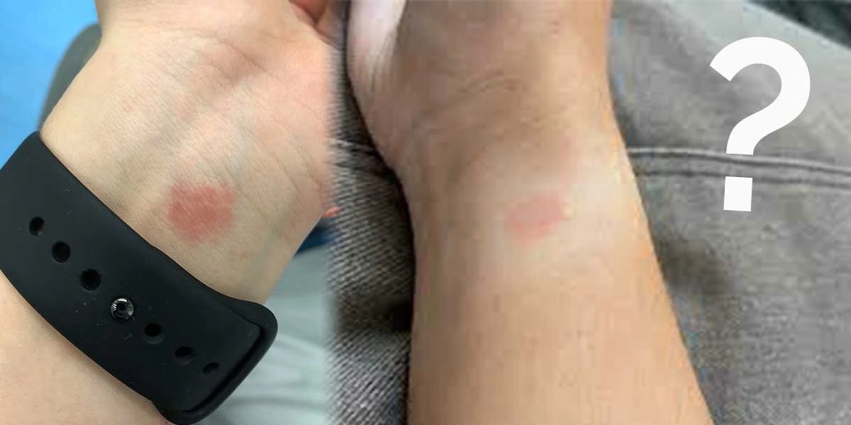 Can Apple Watch Cause Rash? (Explained)
