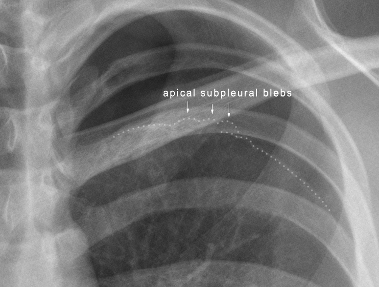 Chronic obstructive pulmonary diseases (PEARLS + Lecture) SMARTY PANCE