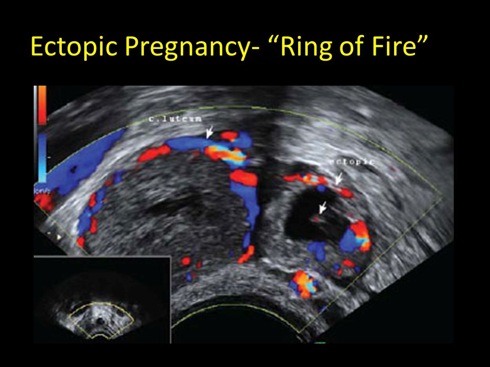 Ectopic pregnancy SMARTY PANCE