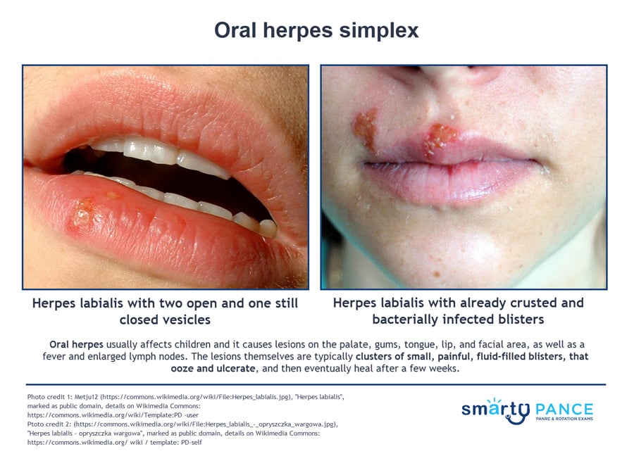 Oral Herpes Gums