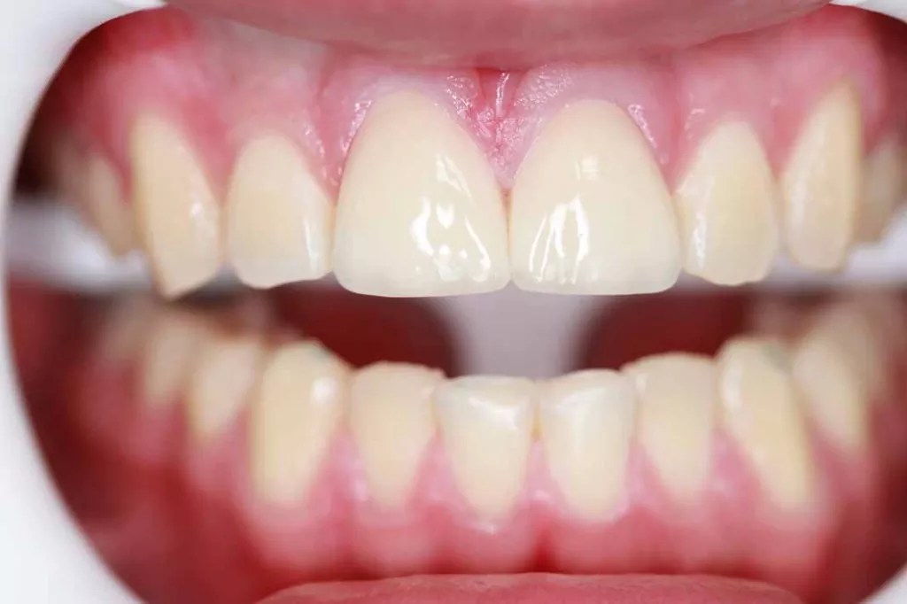 Before & After Affordable Dentist in Tijuana Mexico Tijuana Dentist