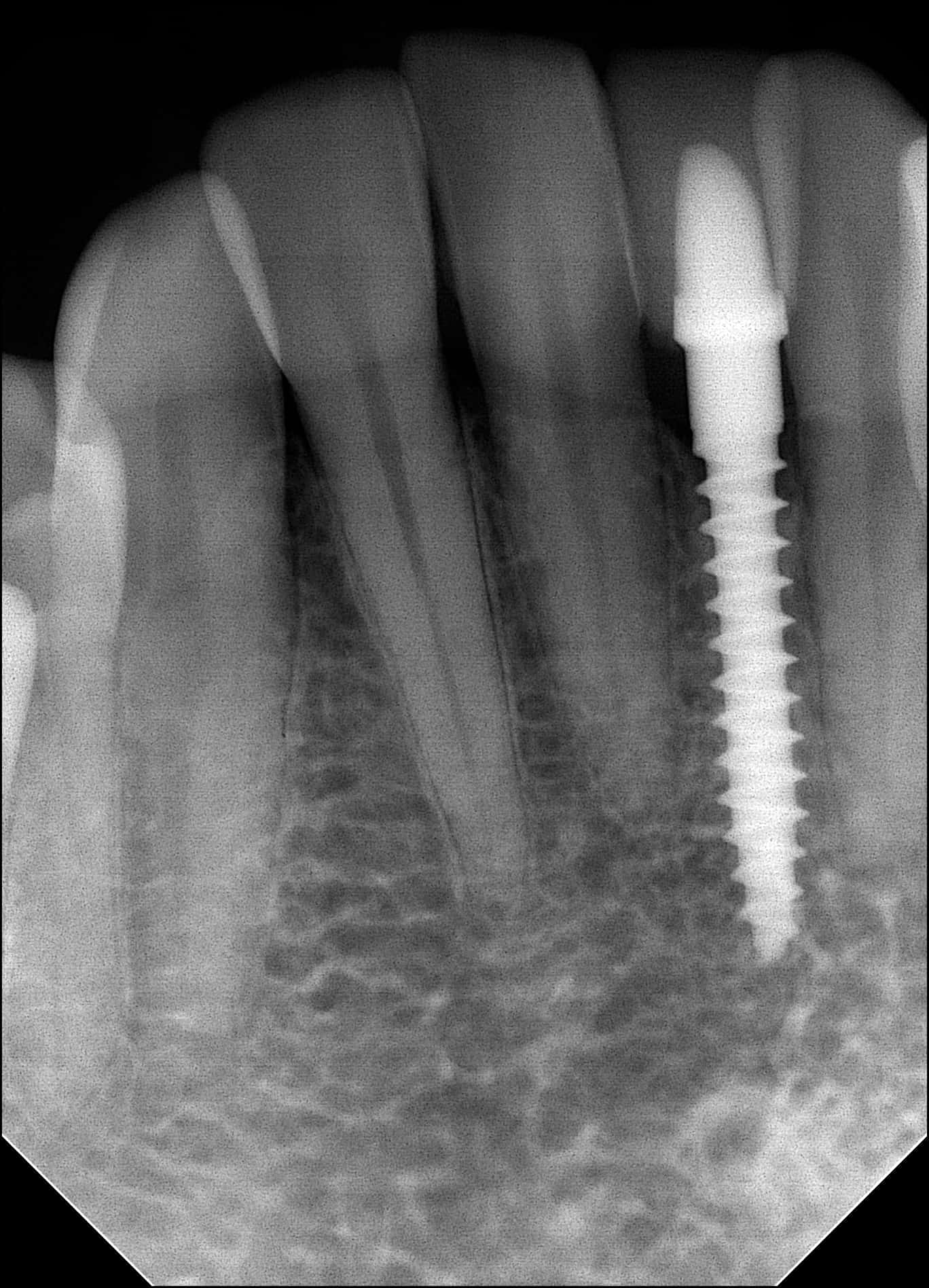 Mini Dental Implants Dental Implants NYC NYC Dentist