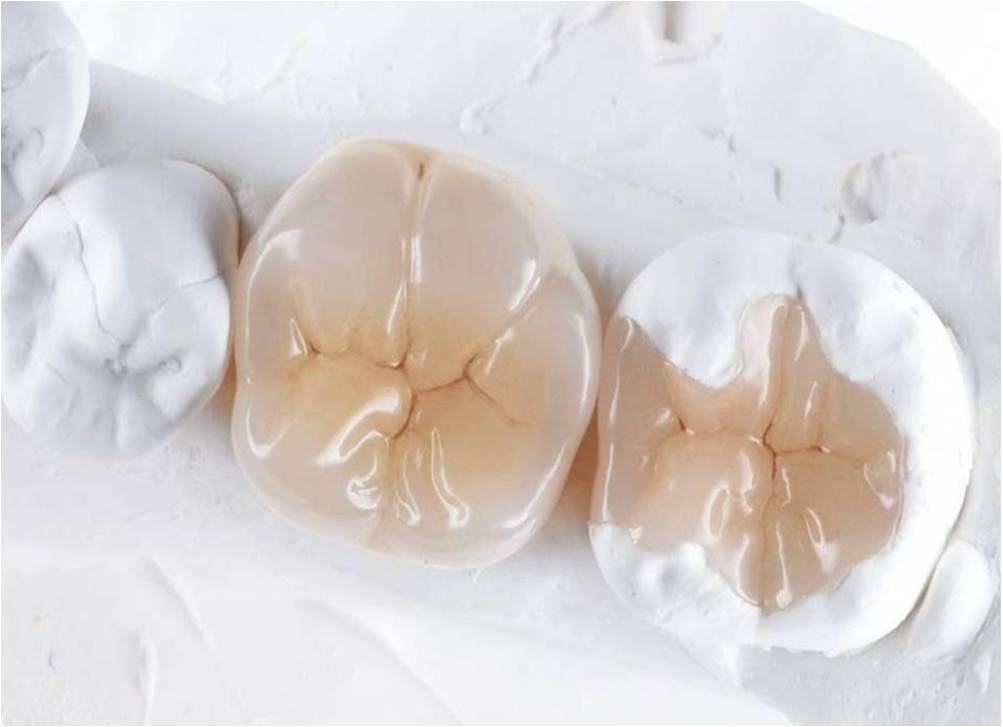 Dental Inlays, Onlays, And Crowns Porcelain Crowns NYC Dentist