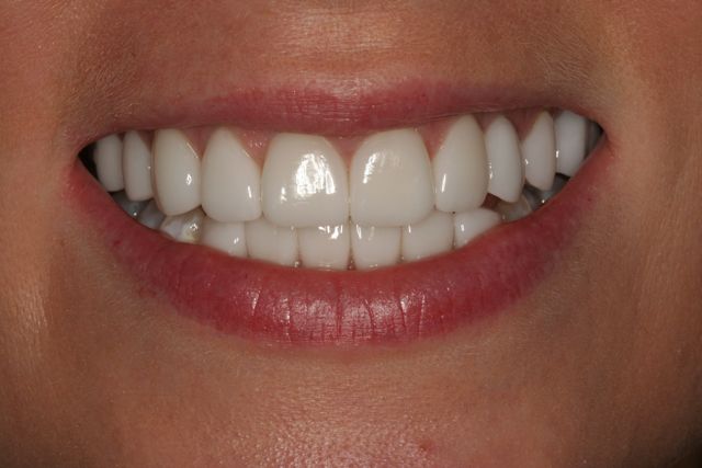 Porcelain Veneers