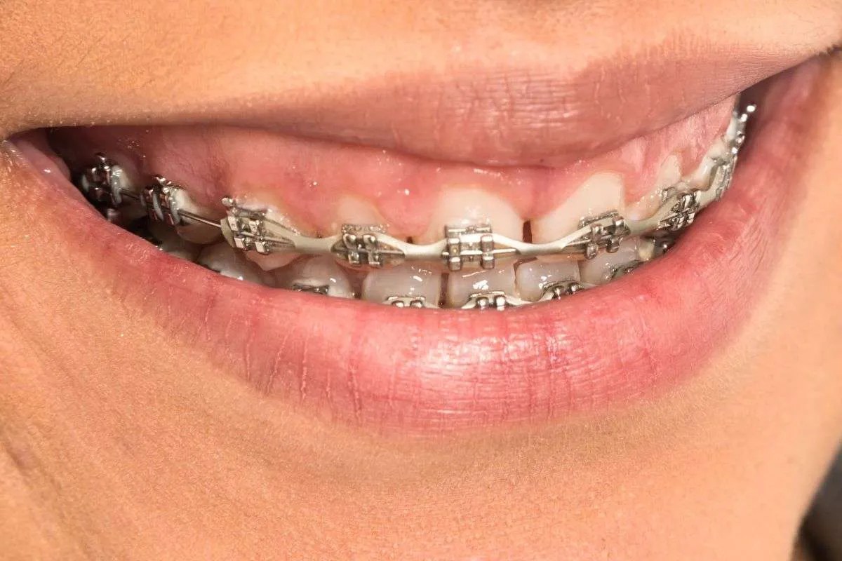 How Long Do Power Chains Take To Close Gaps? Smile Credentials