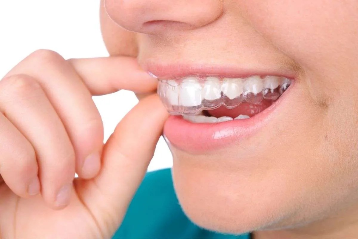 How To Make Your Retainer Fit Again? Smile Credentials