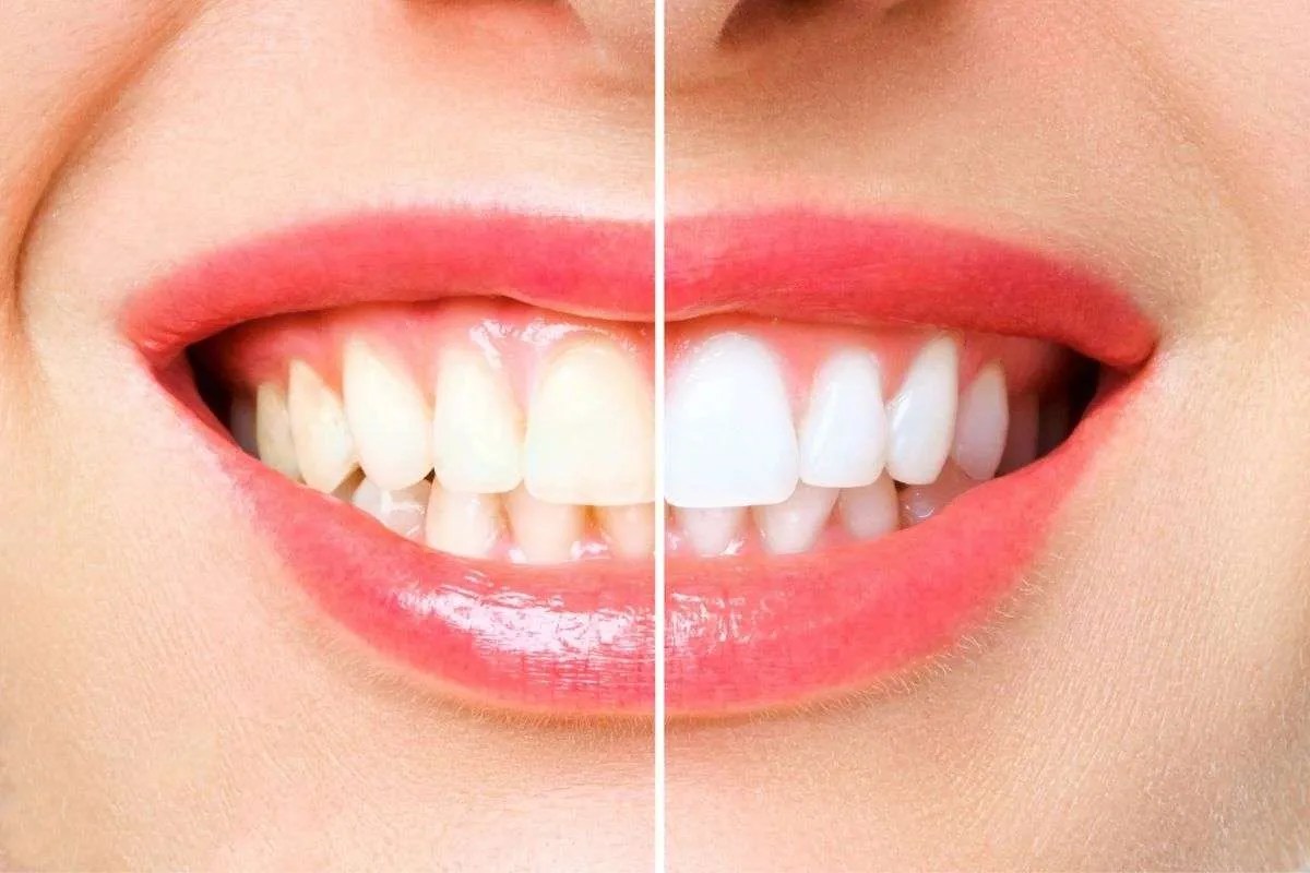 How White Should Teeth Be? Smile Credentials