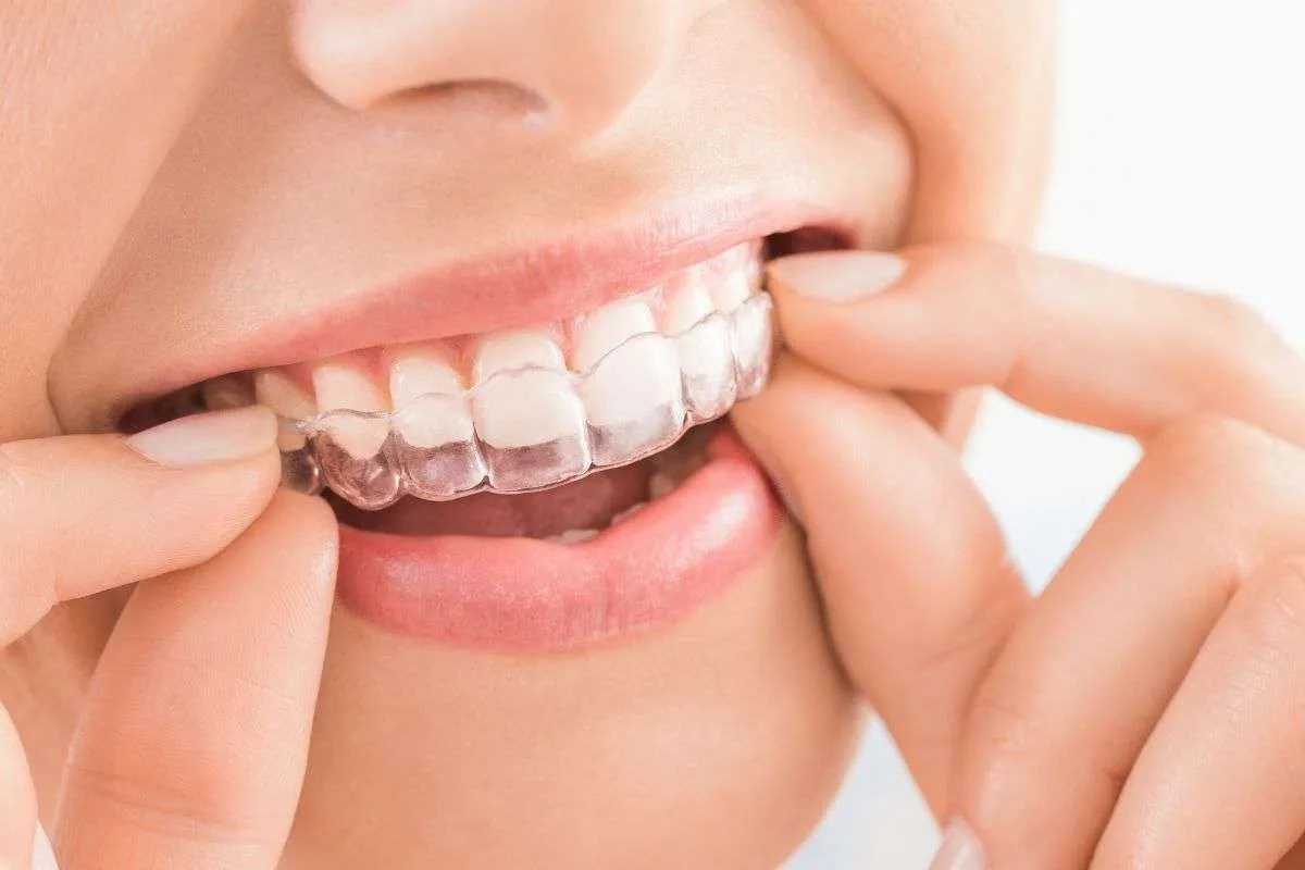 How Often Do You Change Invisalign Trays? Smile Credentials