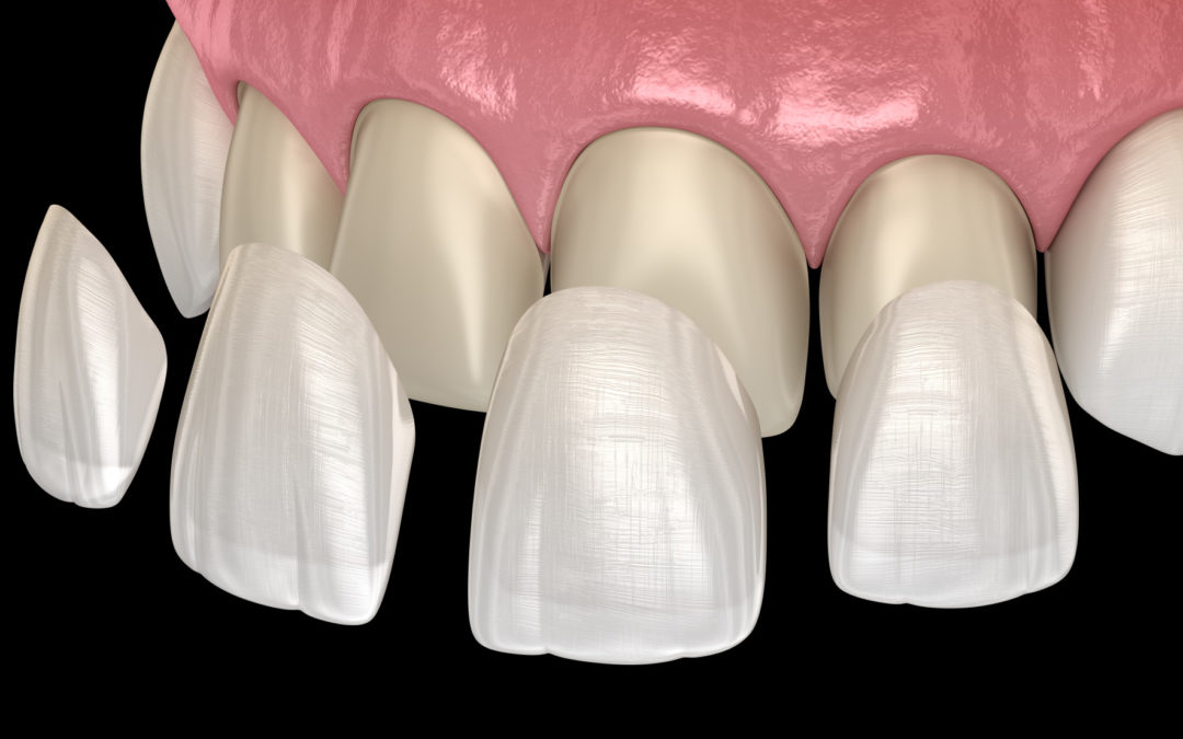 How Much are Veneers? What You Need to Know Smile Design Studio