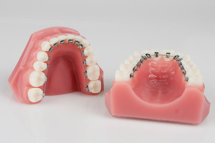 Incognito Lingual Braces in London Treatment and Cost