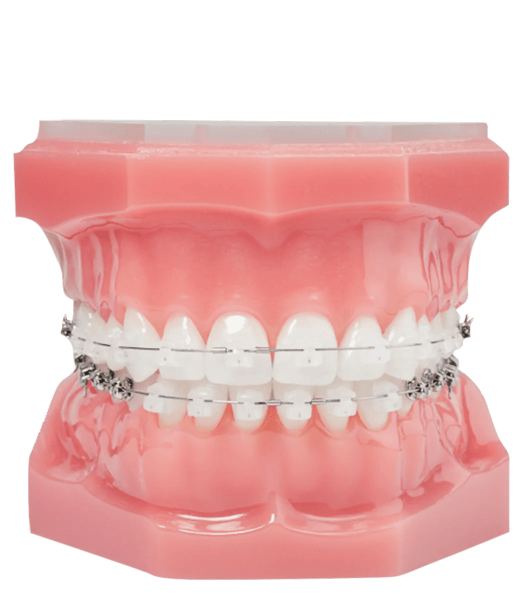 Invisible Braces Tamworth Clear Ceramic Braces in Tamworth