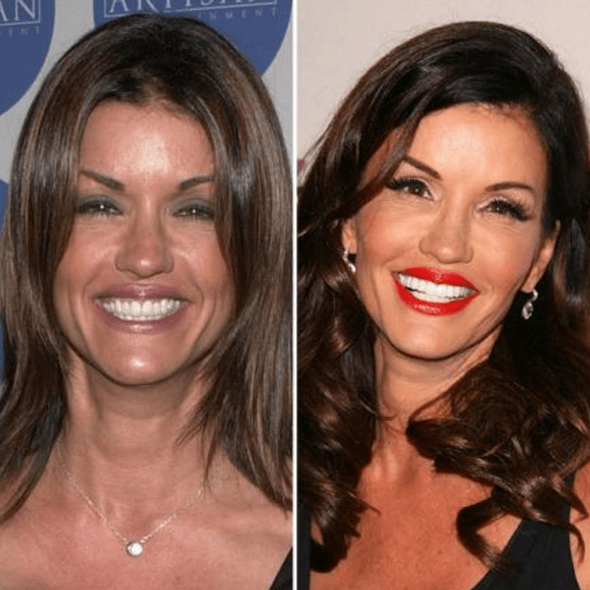 Celebrities Who Have Veneers