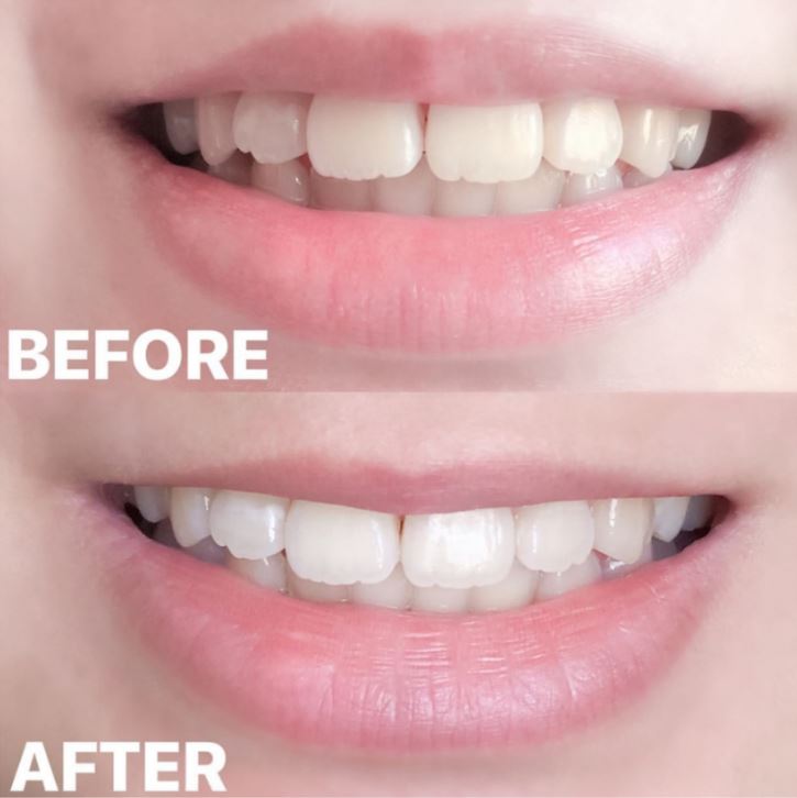 FLASH speed whitening toothpaste — Smilelab