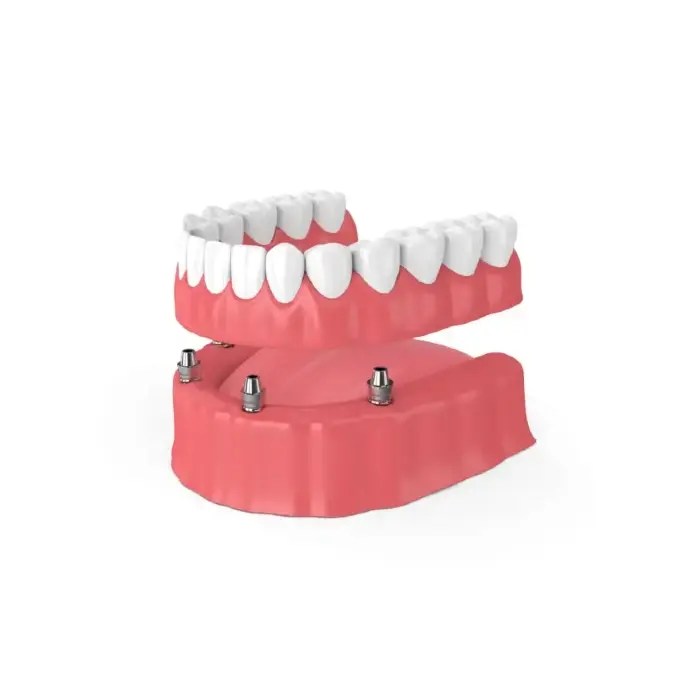 Dentures Denver, CO Smile Now Denver Dentures & Implants