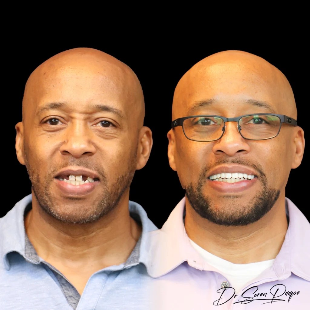 Affordable Dental Implants Denver, CO Smile Now Denver Dentures