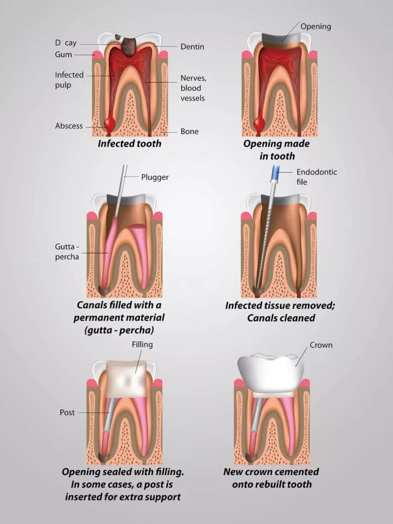 Professional Root Canal Treatment in Lahore SmileOn Dentist