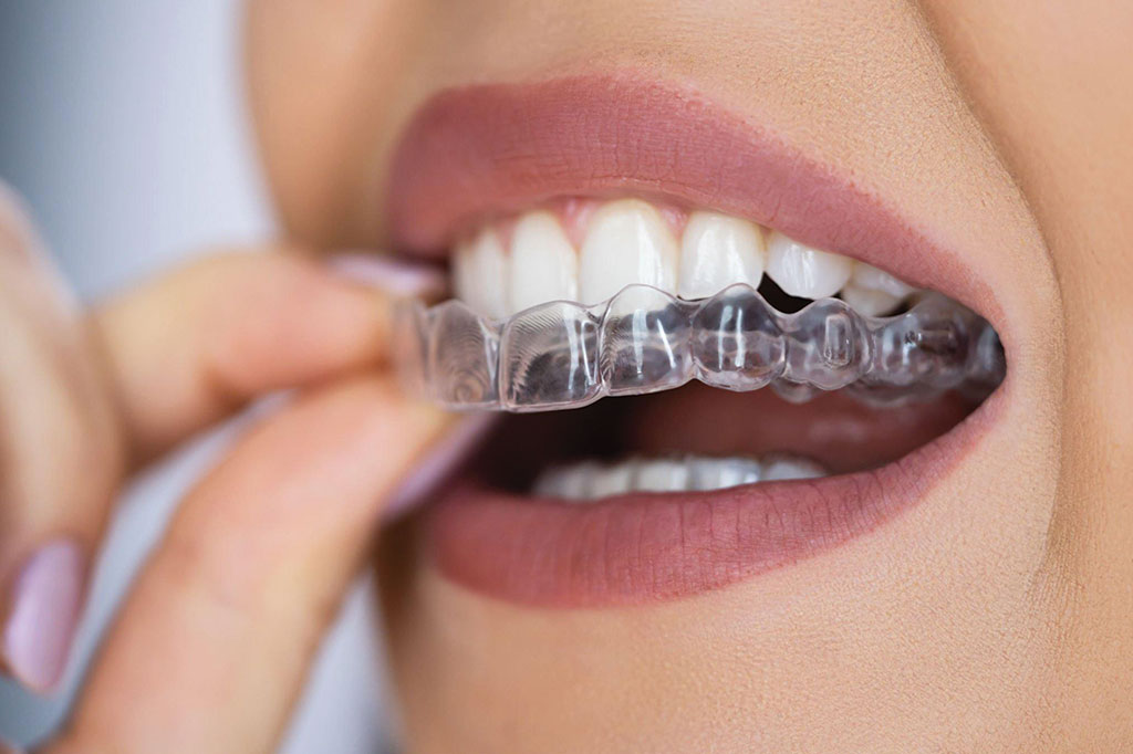 Invisalign Braces Smile Plus Dental Dr Falguni Patel Dentist near