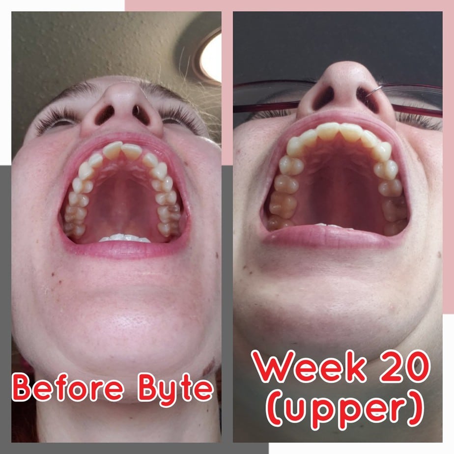 Byte Customer Reviews (Before & After Byte Treatment) Smile Prep