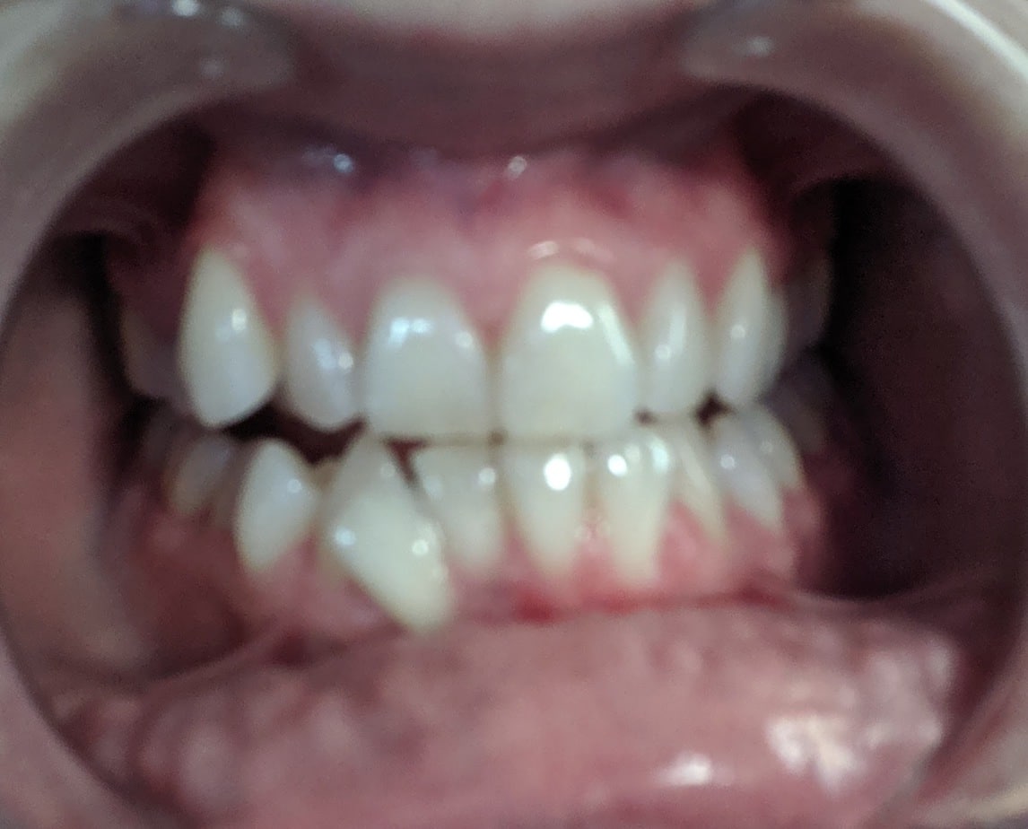 Can Fix Snaggletooth? Real Customer Results