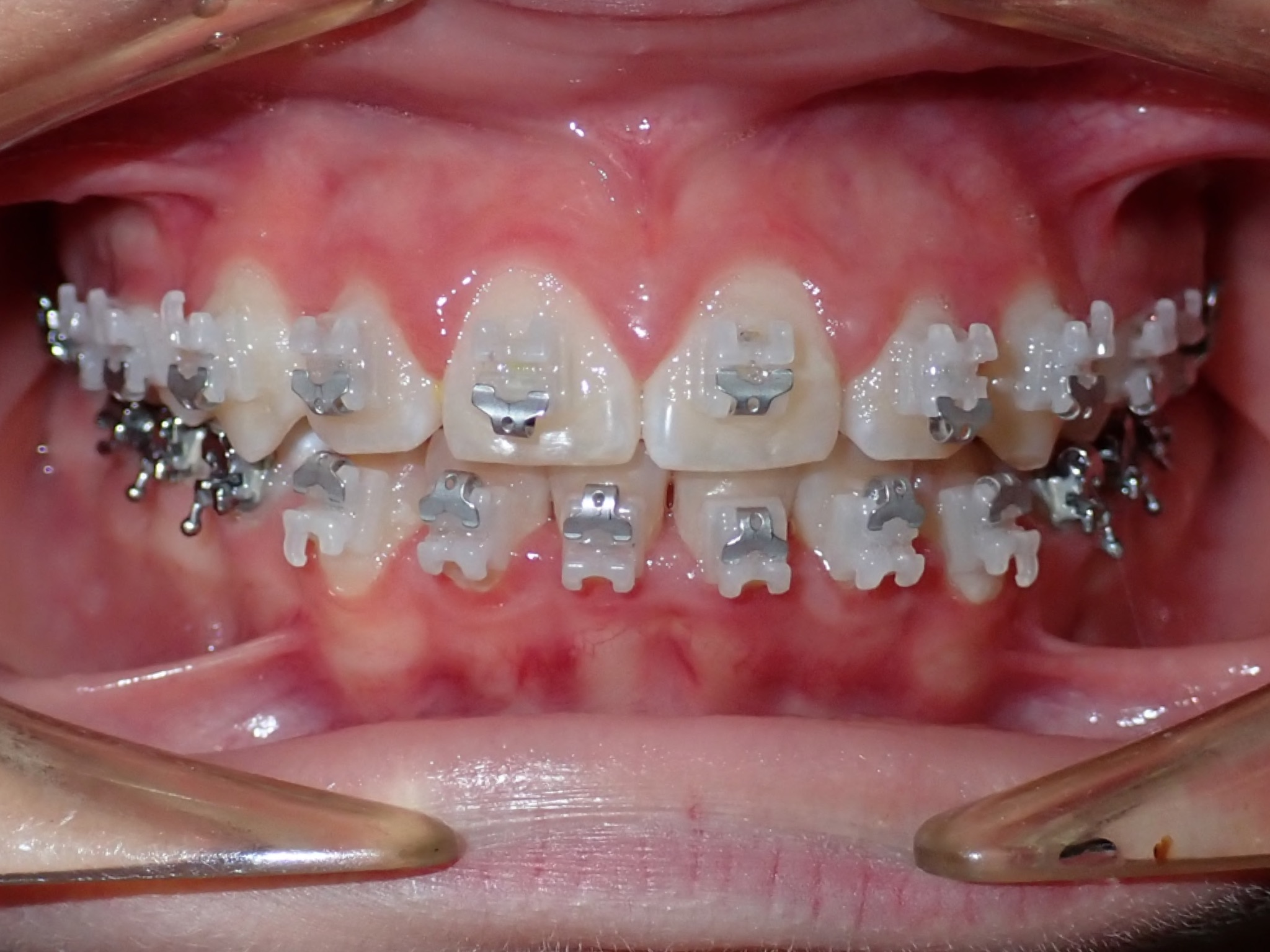 Braces Dr Silvia Menendez Smiles Orthodontics at El Paso Texas