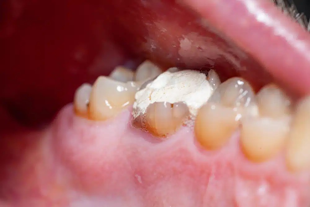 How to fix a Broken Tooth A Comprehensive Guide