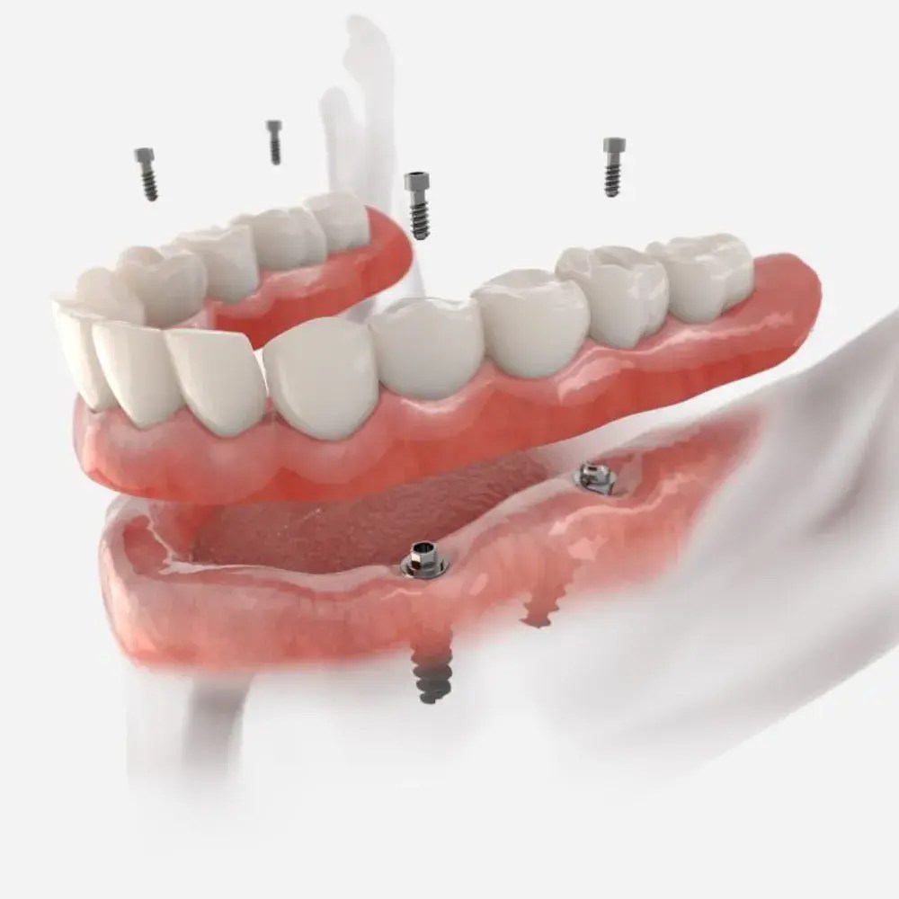 California's Leading AllonX Dental Implants Smile Transformation