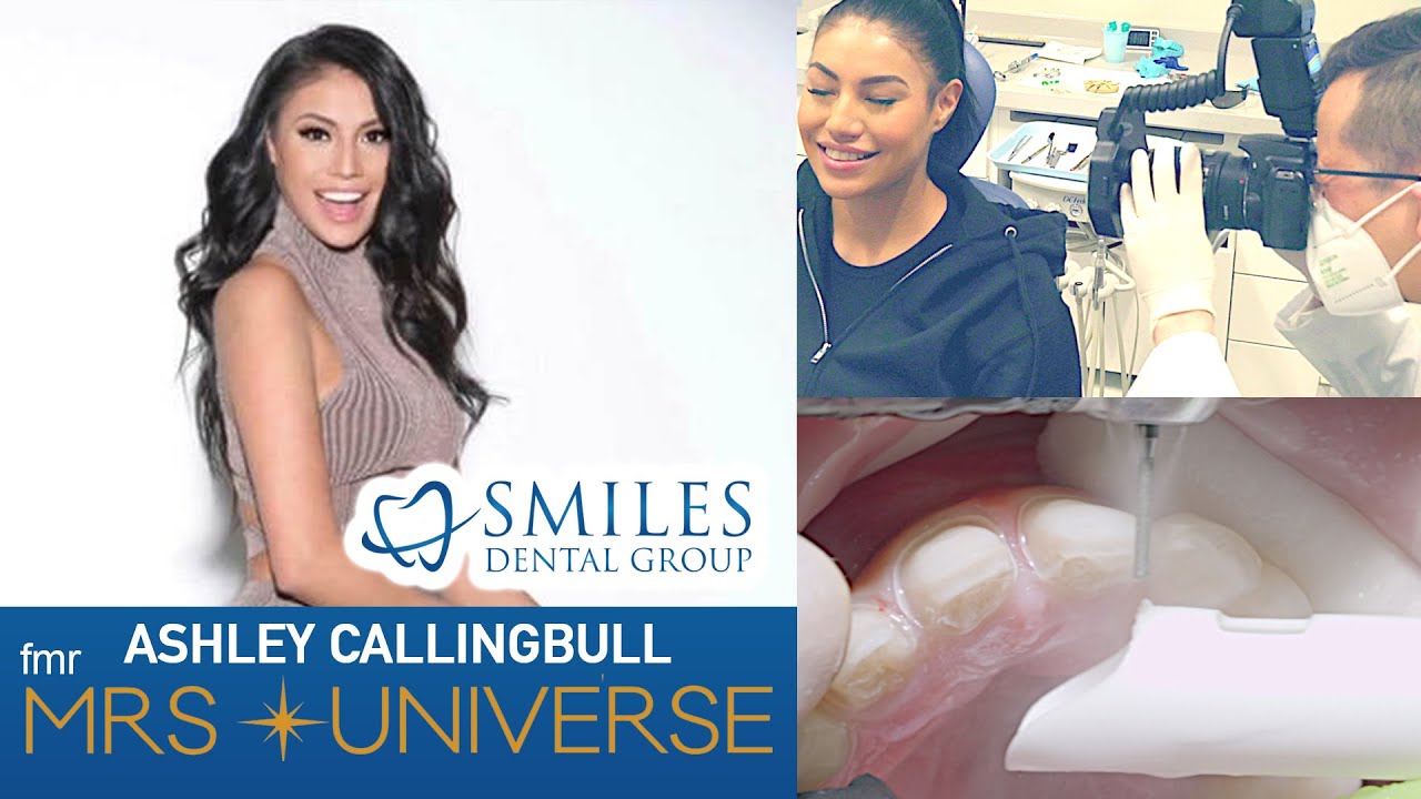 Porcelain Veneers In Edmonton Smiles Dental Group