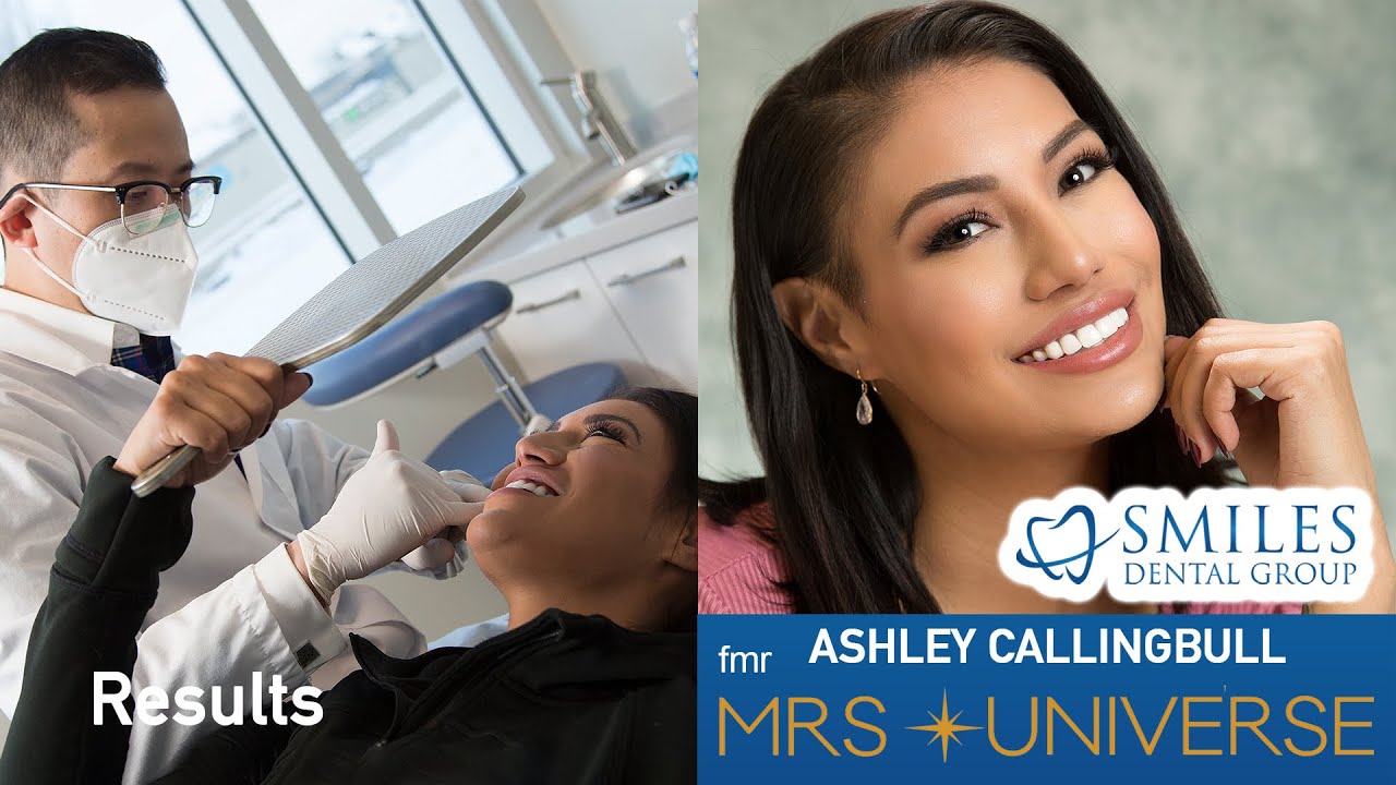 Porcelain Veneers In Edmonton Smiles Dental Group