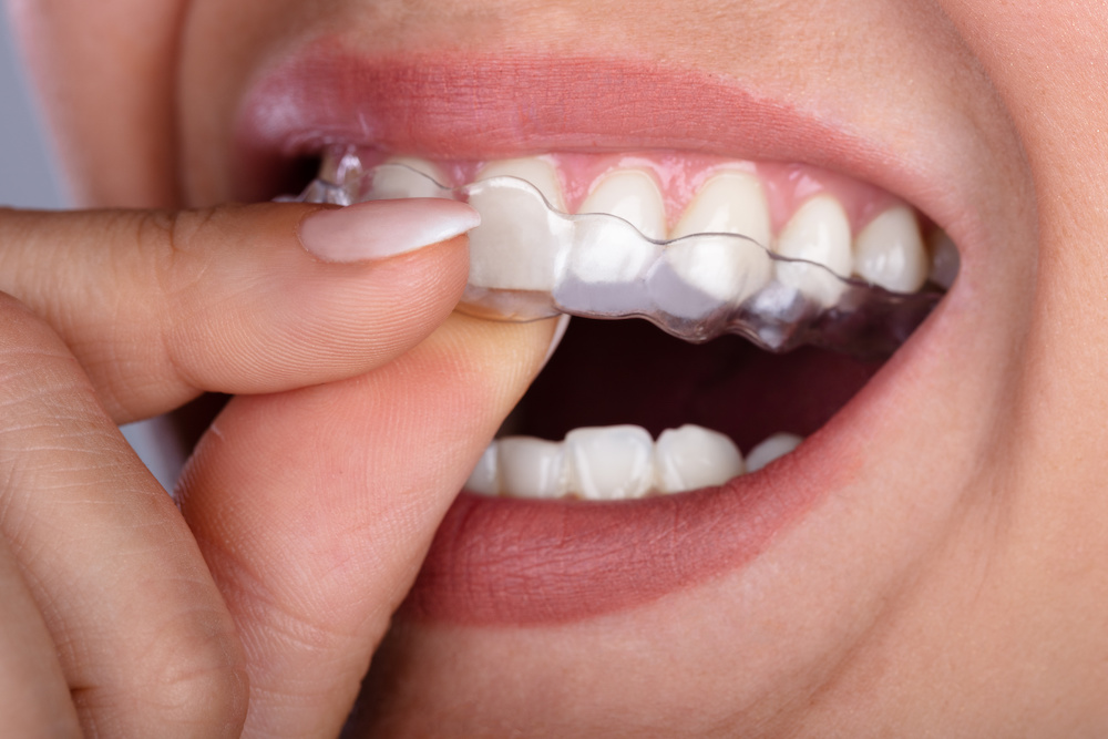 My Invisalign Hurts My Gums What Are My Options? Smile Society