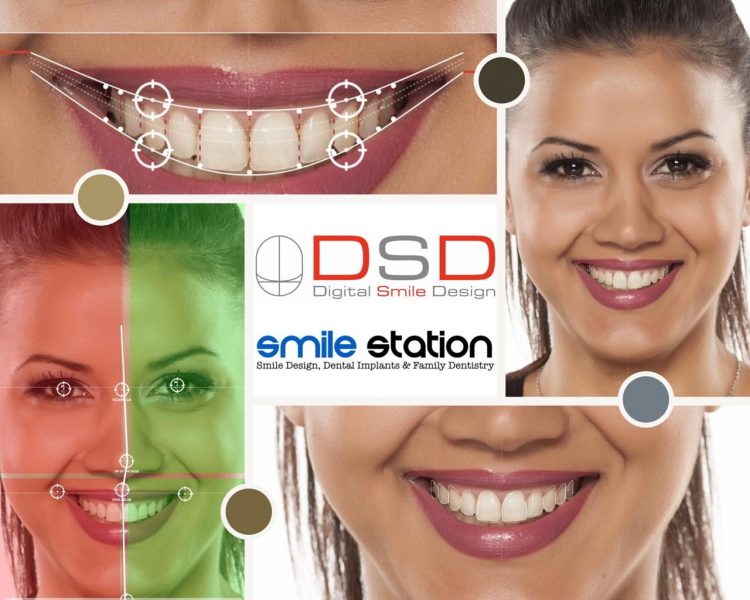 Digital Smile Design by Smile Station Dental Clinic Bangalore