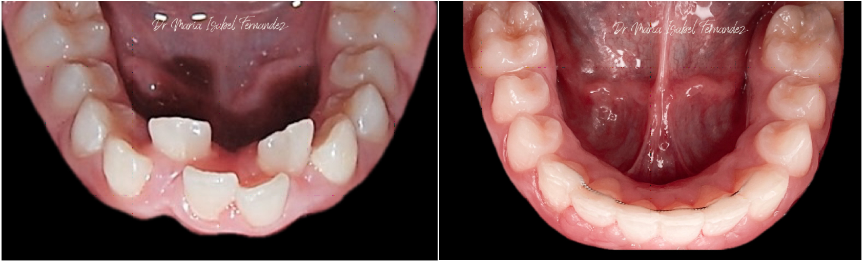 6 DIFFERENT TYPES OF BITE PROBLEMS THAT REQUIRE ORTHODONTIC TREATMENT