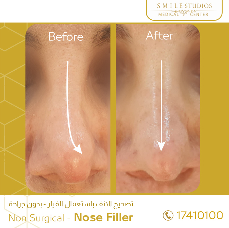 Hyaluronic acid Nose Gallery Smile Studios Best Medical Center in