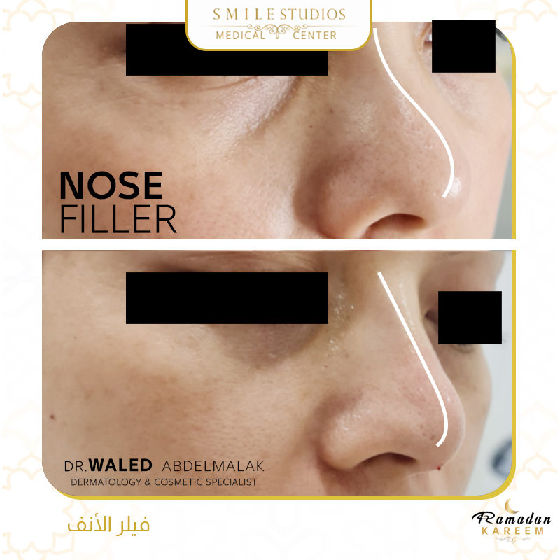Hyaluronic acid Nose Gallery Smile Studios Best Medical Center in