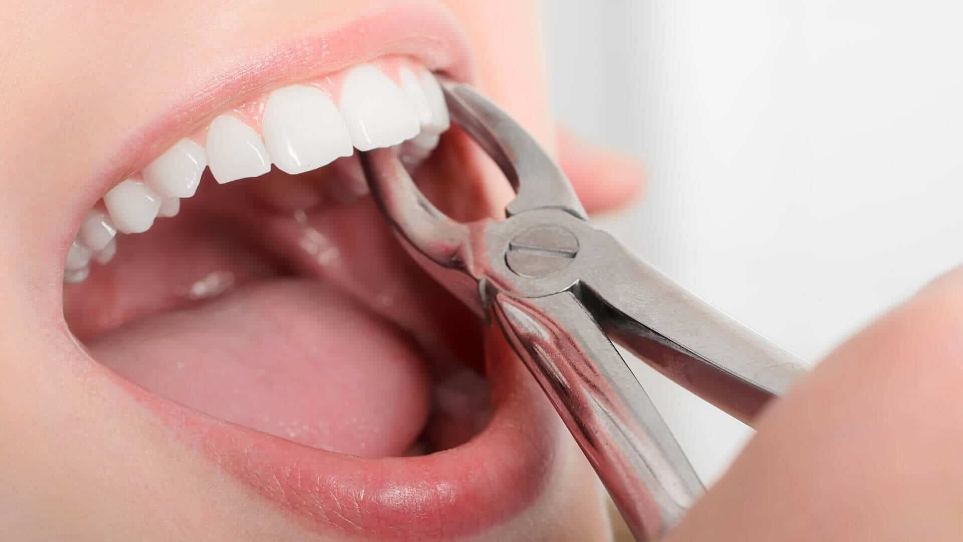 Tooth Extraction Cost, Procedure And The Recovery Phase
