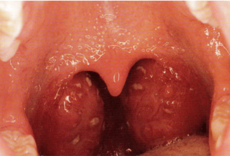 Tonsilitis What is Tonsilitis? Symptoms & Treatment ENT Specialist